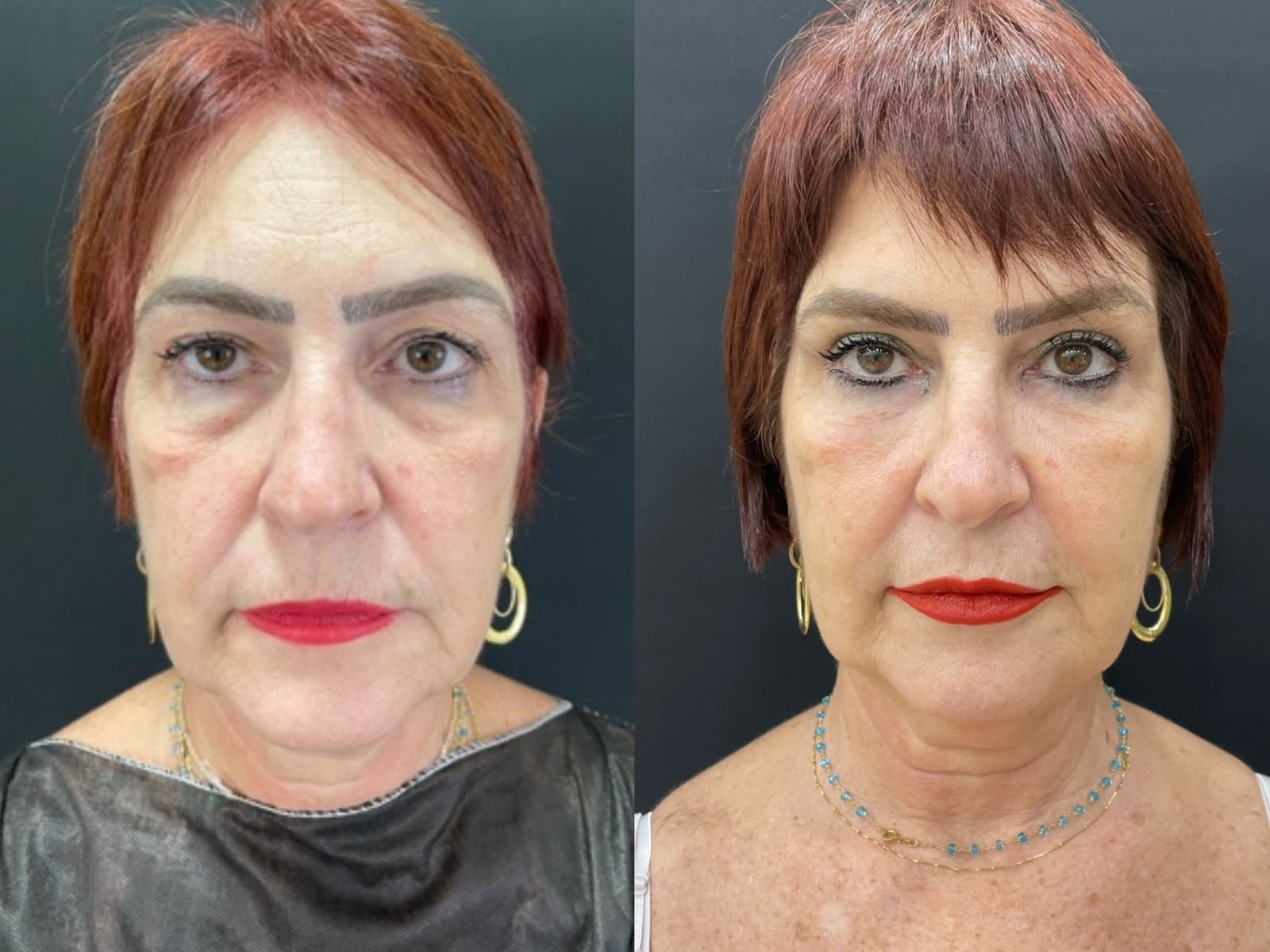 Fios de Tracao e Fios Lisos de PDO